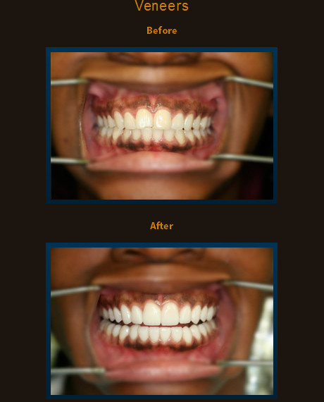 Twenty veneers were used here, the patient’s concerns were symmetry and color without ortho. Ten upper and ten lower veneers were added to complete this smile.