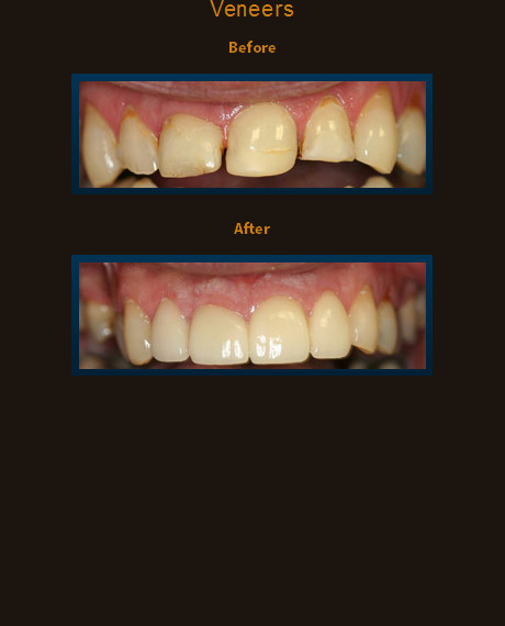 Four veneers were added to improve this patient's smile.