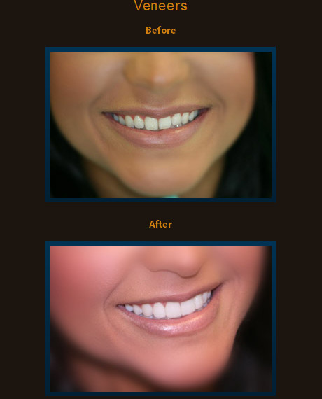 This patient wasn’t happy with her smile. After four front veneers she now loves her new smile!