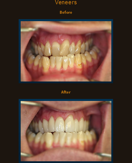 Instant Orthodontics using only 8 veneers on upper teeth.