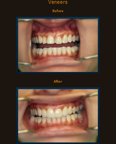This smile was corrected using with 4 veneers.