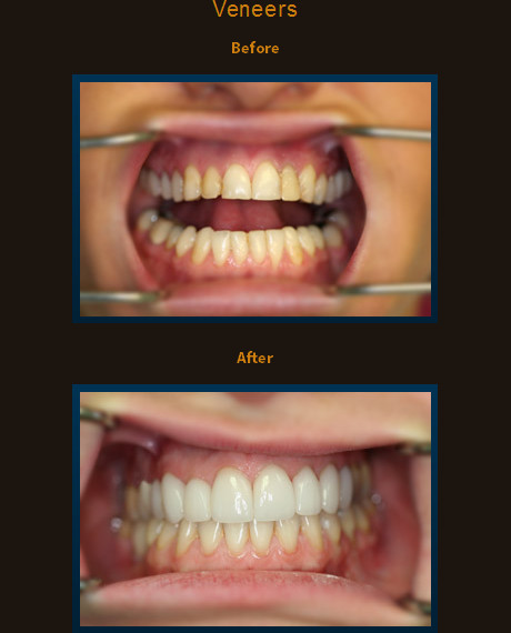 Dr. Scurti improved this smile with 8 veneers.