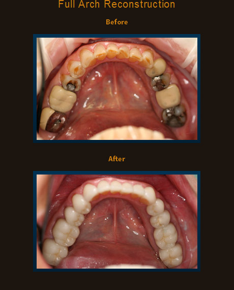 Full arch reconstruction to establish proper bite and function. All lower teeth were addressed and restored with combination of crowns and veneers.