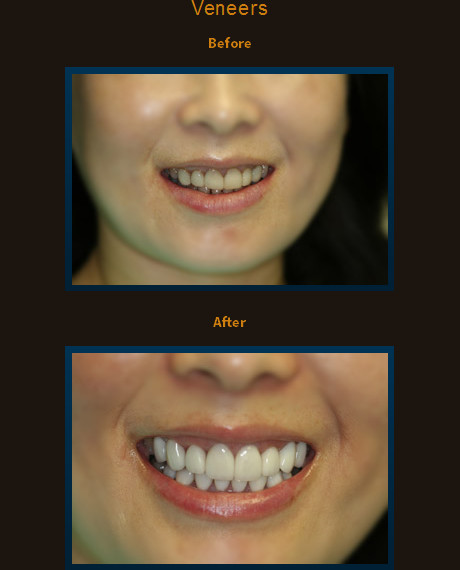 Smile redesign with upper and lower veneers.