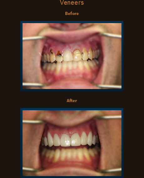 Dr. Scurti was able to save the patients front teeth by removing decay and placing 8 porcelain veneers.