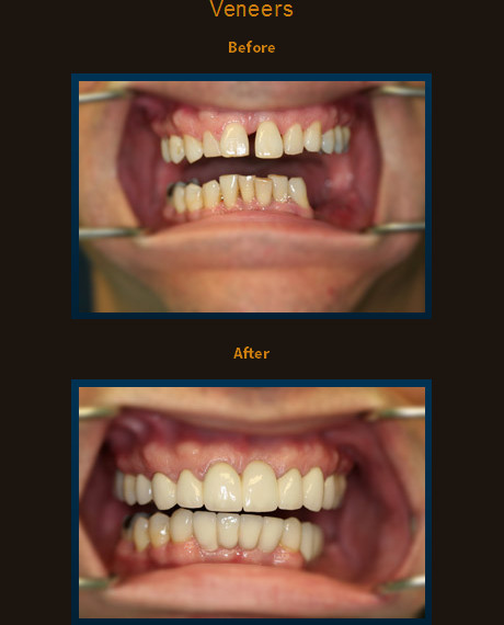 Combination of upper and lower implants, crowns and veneers were placed to address patients TMJ and improve smile.